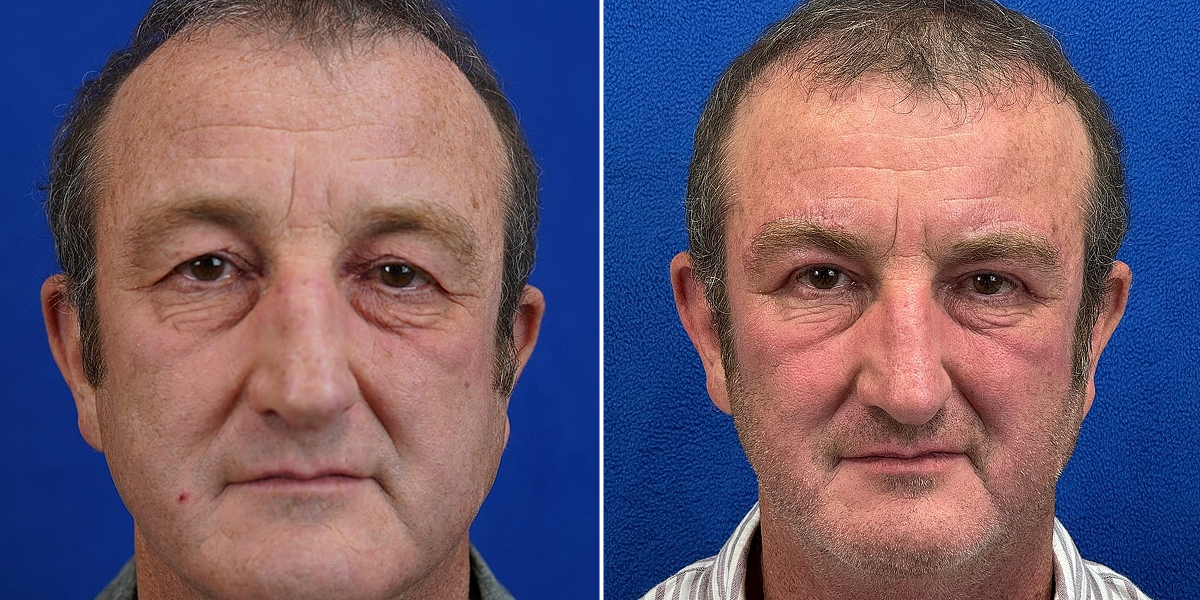 Before and after 1 - Blepharoplasty