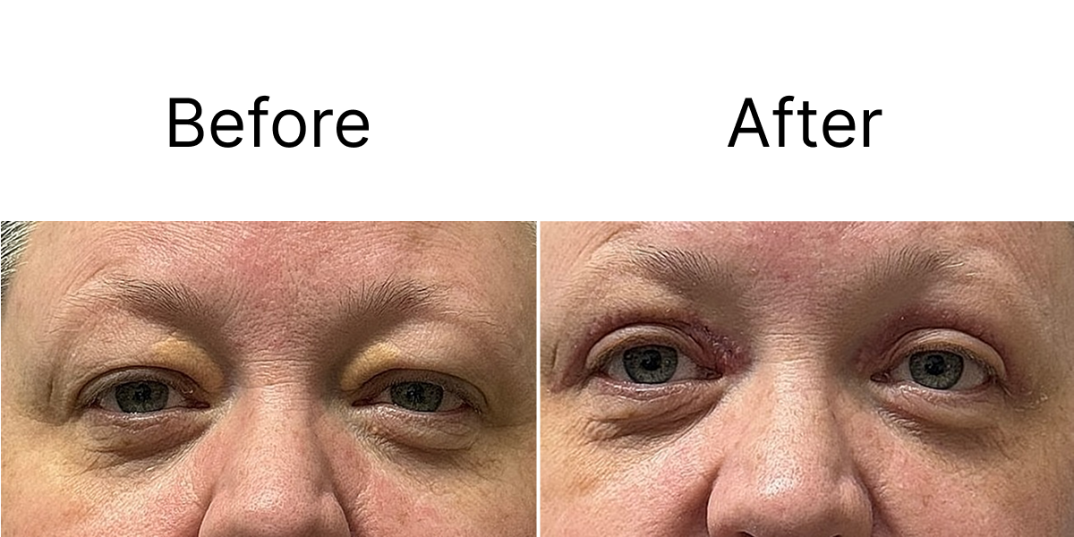 Before and after 2 - Blepharoplasty