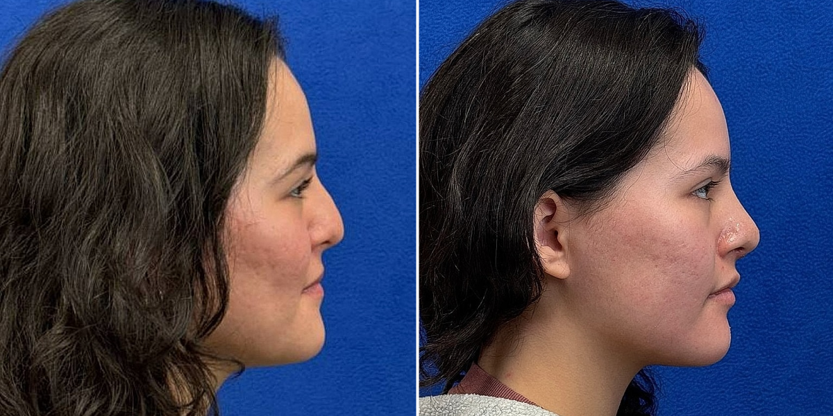 Before and after 3 - Rhinoplasty