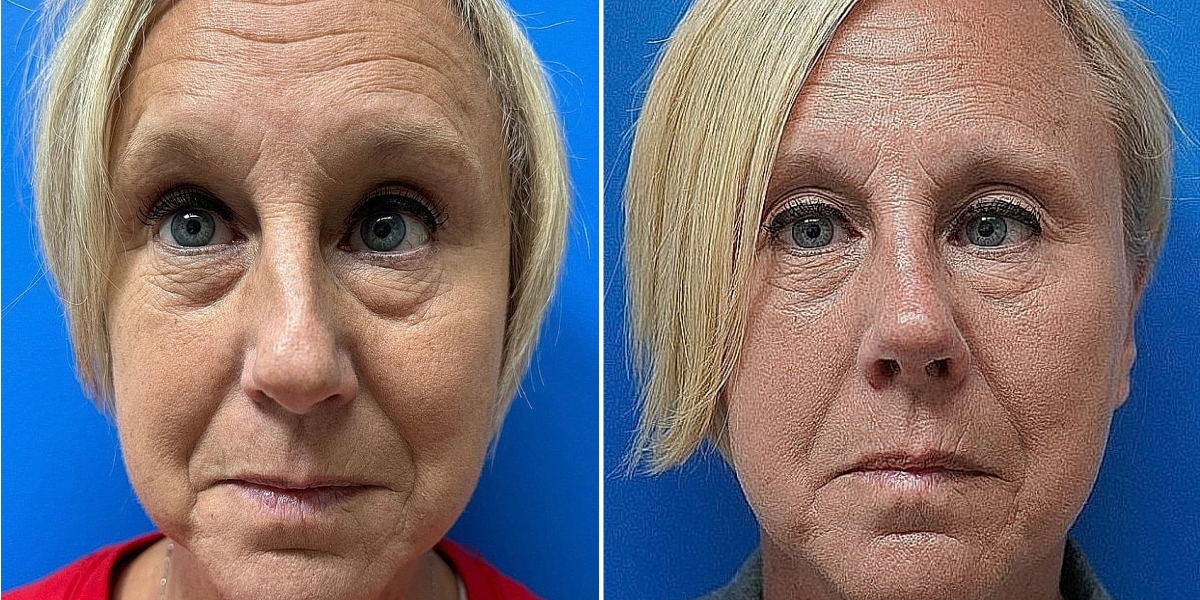 Before and after 5 - Rhinoplasty