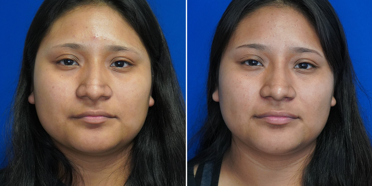 Before and after 6 - Rhinoplasty
